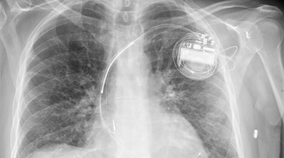 Medical implants vulnerable to cyber attacks, experts warn