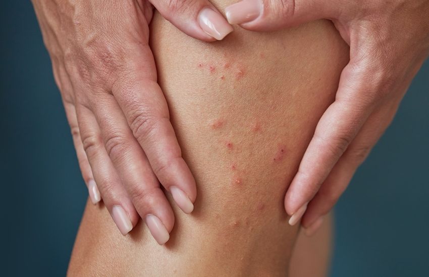 Some CI pharmacists report scabies medication shortage, as UK sees spike in cases