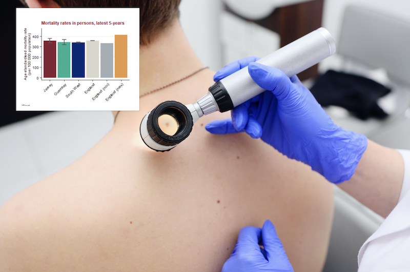 Higher rates of Melanoma in Guernsey than UK
