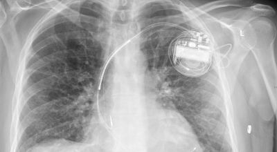 Medical implants vulnerable to cyber attacks, experts warn